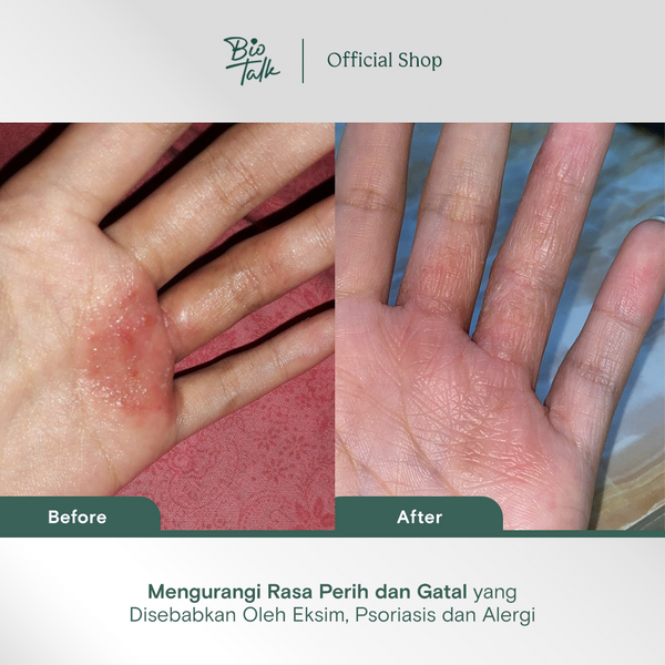 [NEW LAUNCH] Biotalk Natural Calendula Salve Mini I 15gr I No Steroid I Meredakan Kulit Eksim Psoriasis Sensitif Gatal-Gatal I Membantu Meredakan Alergi Kulit Gatal