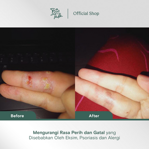 [NEW LAUNCH] Biotalk Natural Calendula Salve Mini I 15gr I No Steroid I Meredakan Kulit Eksim Psoriasis Sensitif Gatal-Gatal I Membantu Meredakan Alergi Kulit Gatal