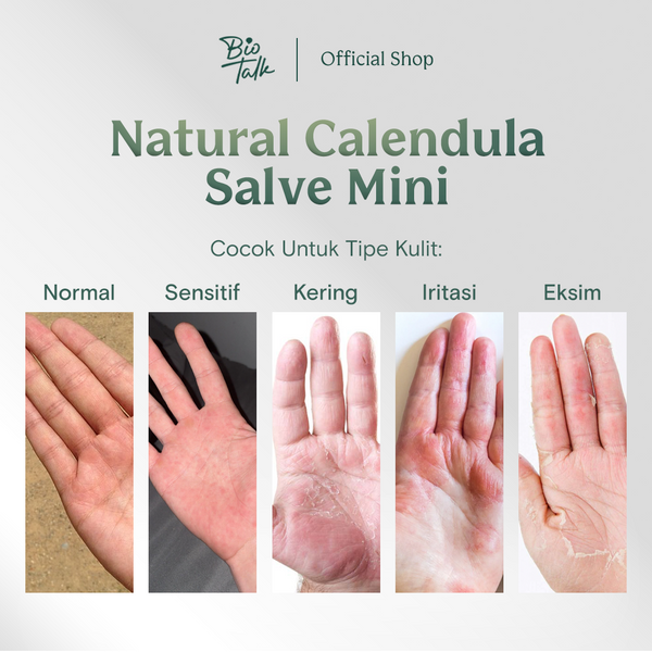 [NEW LAUNCH] Biotalk Natural Calendula Salve Mini I 15gr I No Steroid I Meredakan Kulit Eksim Psoriasis Sensitif Gatal-Gatal I Membantu Meredakan Alergi Kulit Gatal